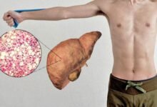 Health Tips : दुबले पतले लोगों का भी लिवर खराब हो सकता है, डॉ अर्चिता महाजन