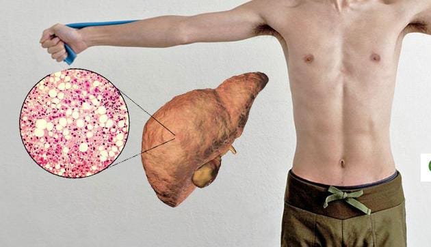 Health Tips : दुबले पतले लोगों का भी लिवर खराब हो सकता है, डॉ अर्चिता महाजन